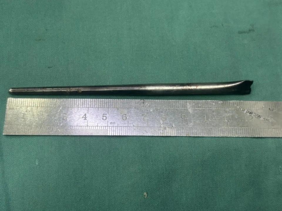 大连一男子8年前误食一根筷子在嗓子眼，男子一直忍忍忍，最后实在疼得受不了去医院后