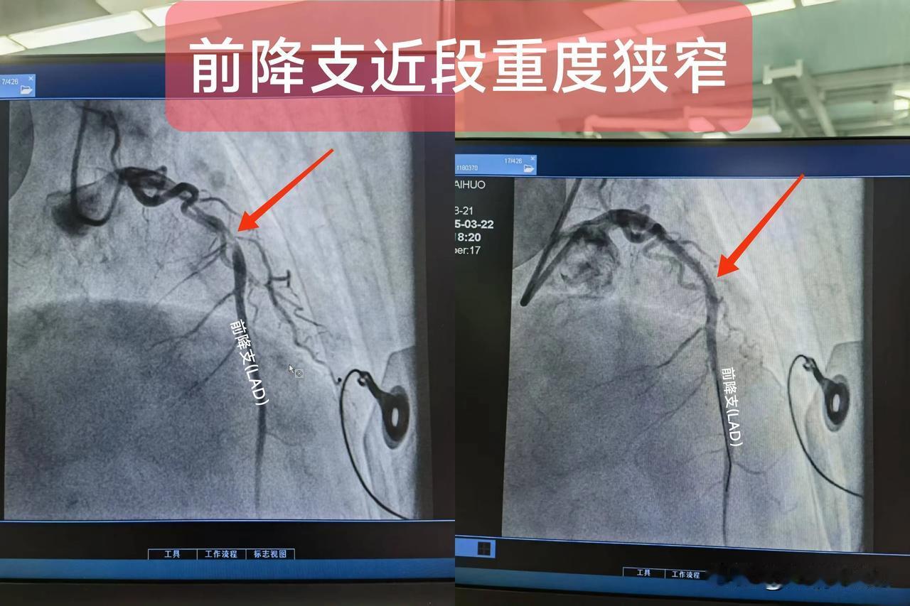 急性ST段抬高型心肌梗死(前降支近段重度狭窄)一.概念：前降支主要为前壁及