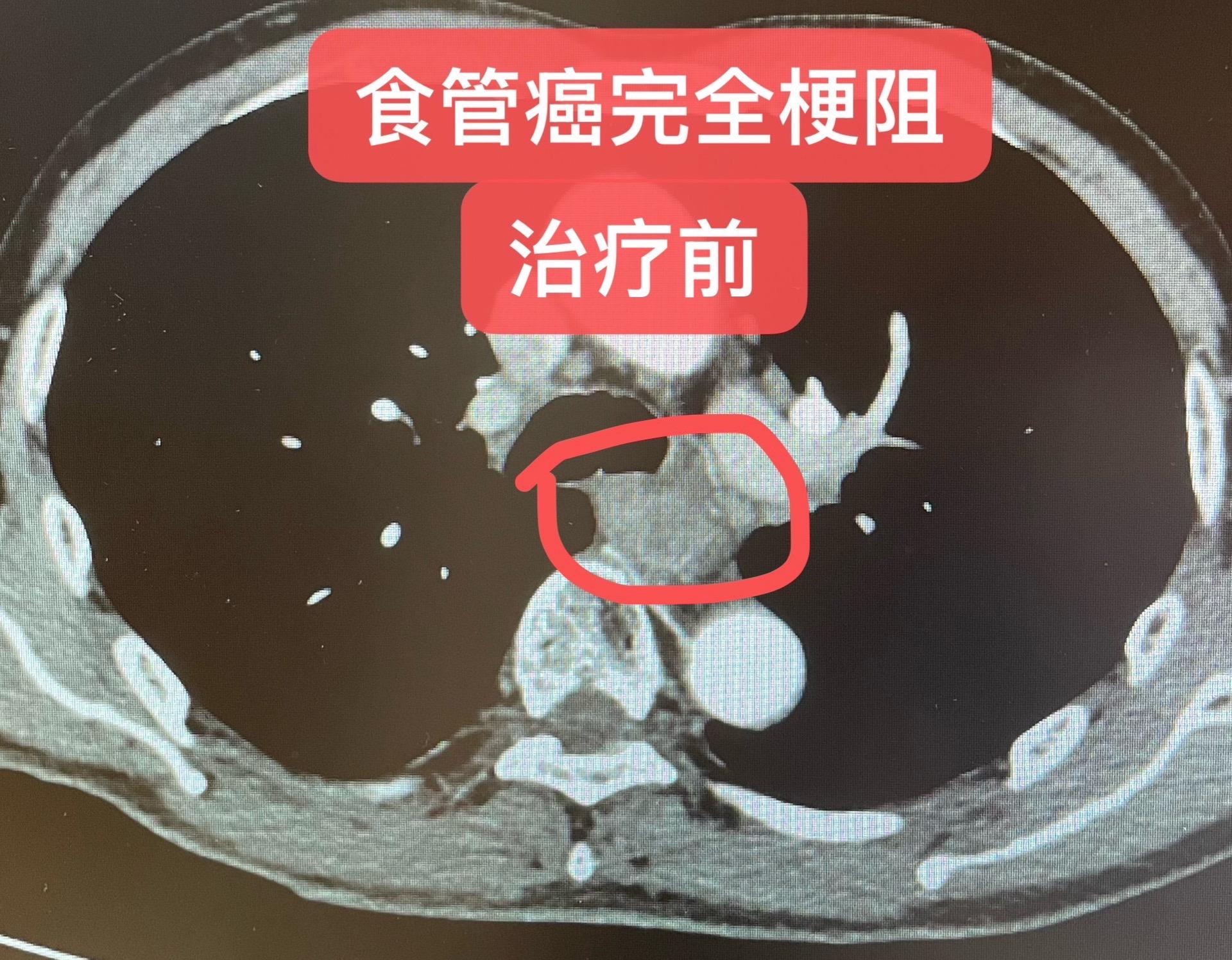 食管癌：局部晚期鳞癌伴高龄。局部晚期食管鳞癌，75岁，T3N2M0，完...