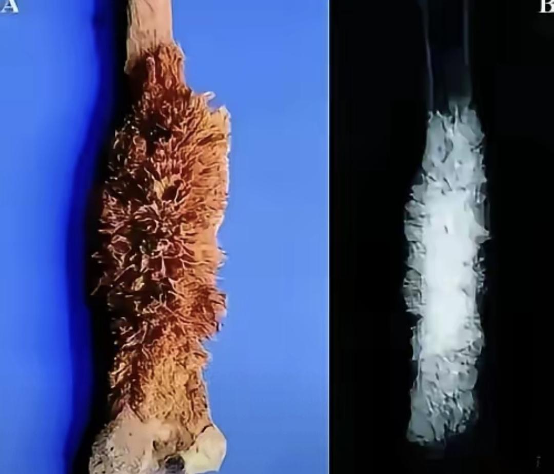 在医学院见到了一具特殊的死人腿骨，表面全是尖刺状的肿瘤。这是个因骨癌去世的患者遗