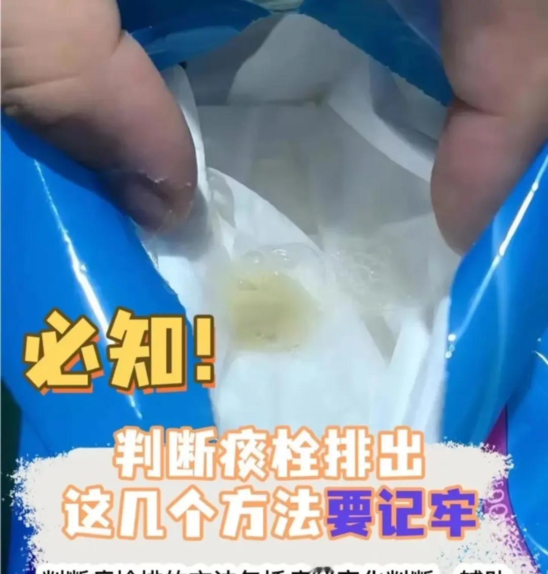 大家甲流后咳嗽严重吗?甲流后的咳嗽早期，干咳合并声音嘶哑，中后期