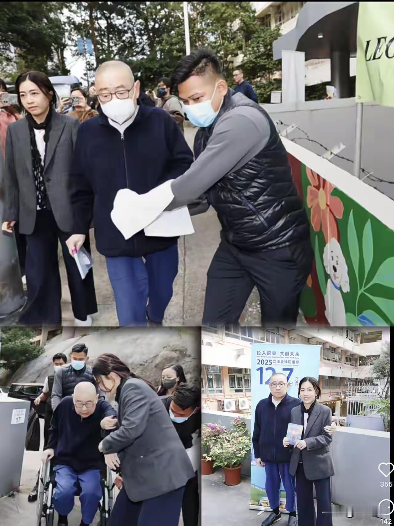 3D打印器官来了！​刘銮雄换肾8年，近几日出现排异反应，高烧40度，尿血严重。