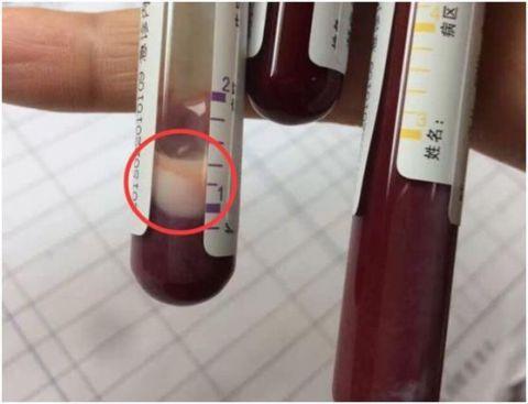 身体发出这5个信号, 说明血液已经“粘得像粥”了, 最好去查查