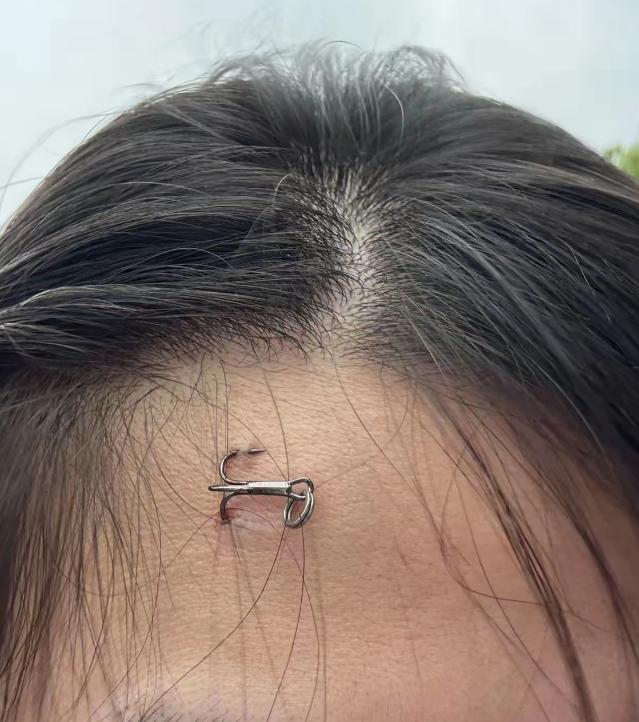 近日，一男子第一次学钓鱼，结果没甩进水里，倒是一钩子扎进了围观女孩的头皮。女孩要