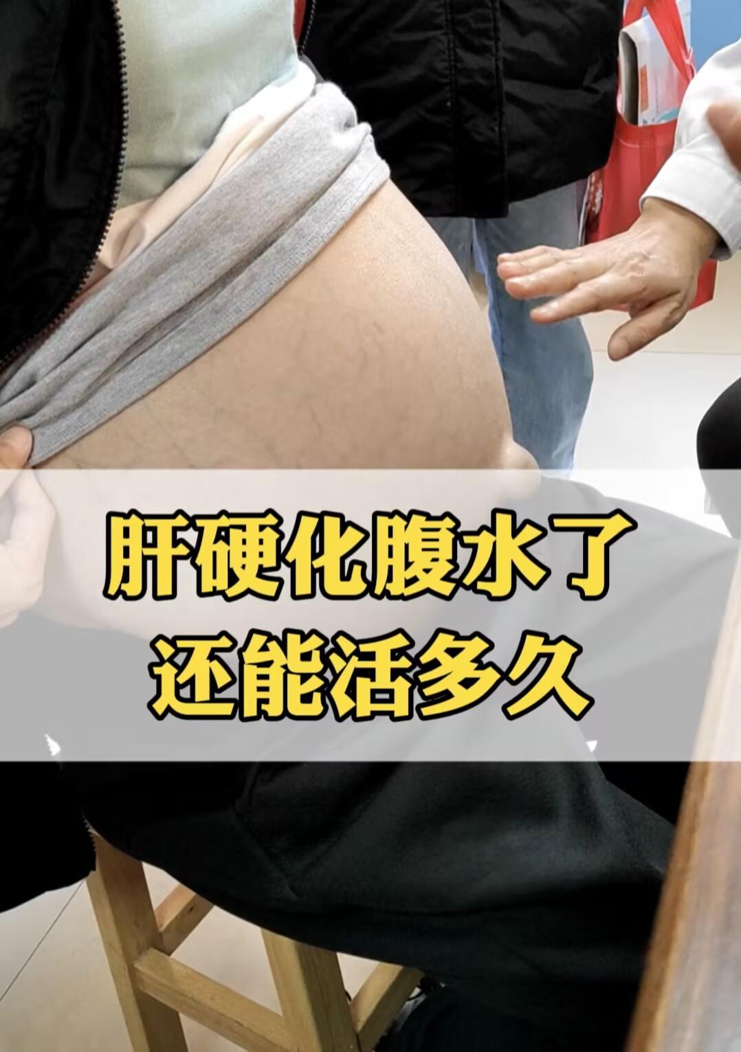 经常有患者攥着我的手问：“肝硬化腹水了，我还能活多久？”每次我都想说...