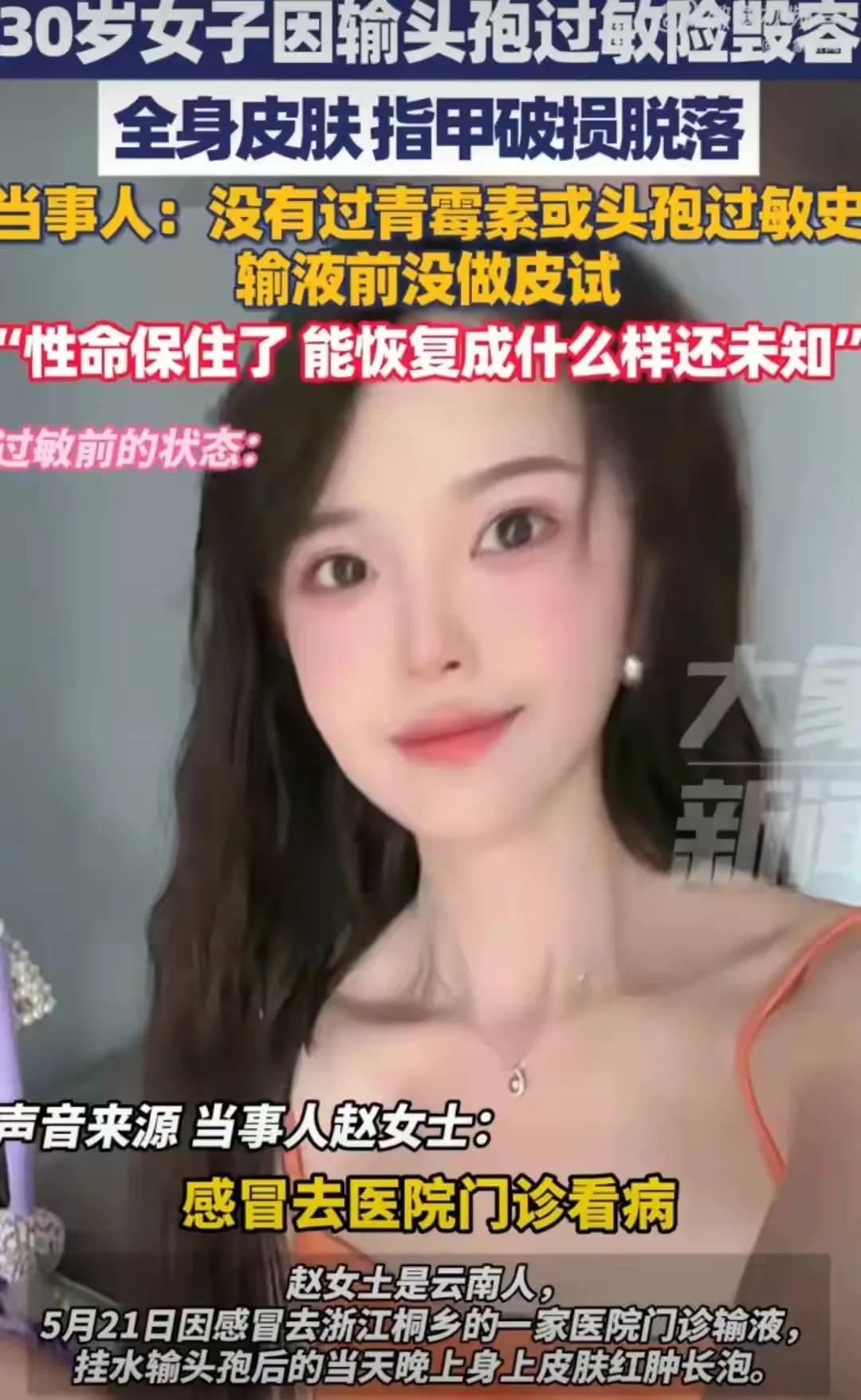 8月25日，30岁女子因为感冒挂水，输液输了头孢过敏，让全身皮肤、指甲破损脱落。