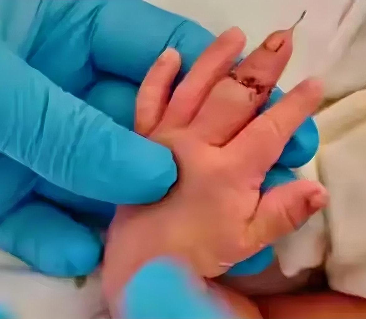 太离谱!江苏一婴儿手指被剪断，院方提出赔10万元，遭家属拒绝江苏淮安盱眙县