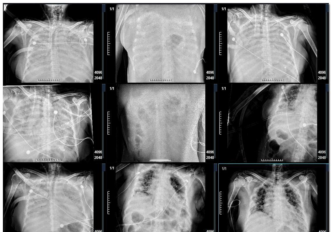 从医这么多年，真没见过比这更凶险的病晚期肺癌在它面前，都算是个“善终”了年前