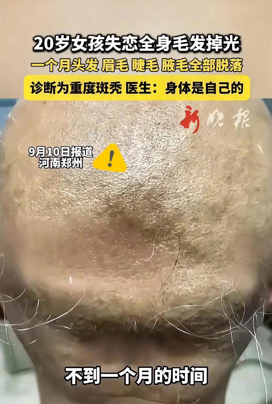 20岁姑娘为情所伤掉光头发？别让一段错的感情，毁了本该闪光的人生！郑州
