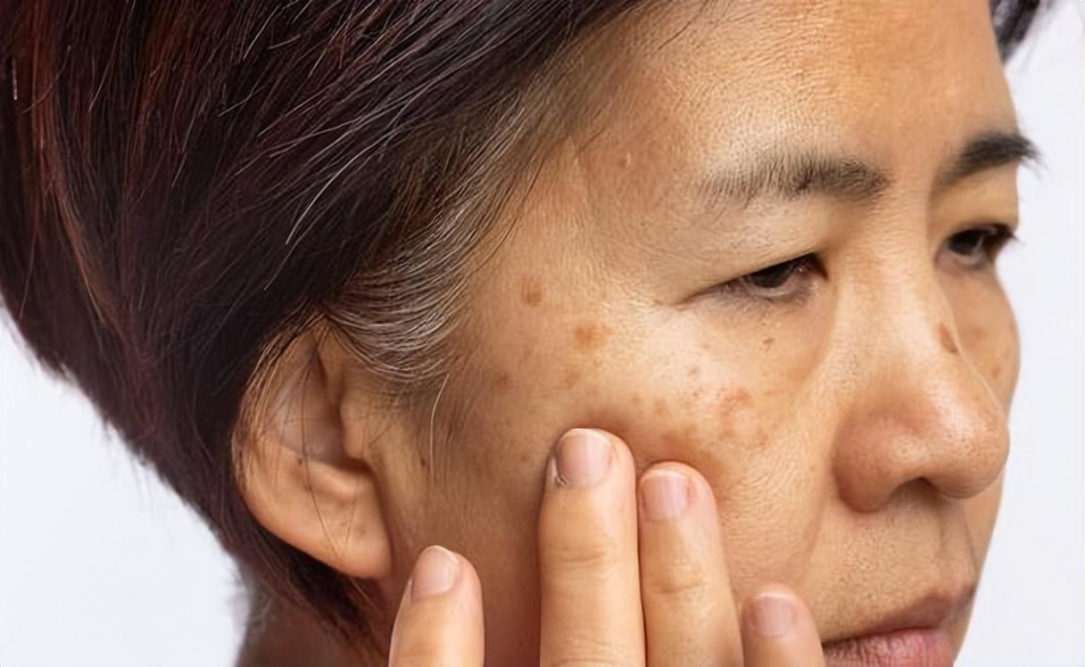 “老年斑”的罪魁祸首被发现，45岁后尽量少去碰，老了也能不长斑很多人觉得老年