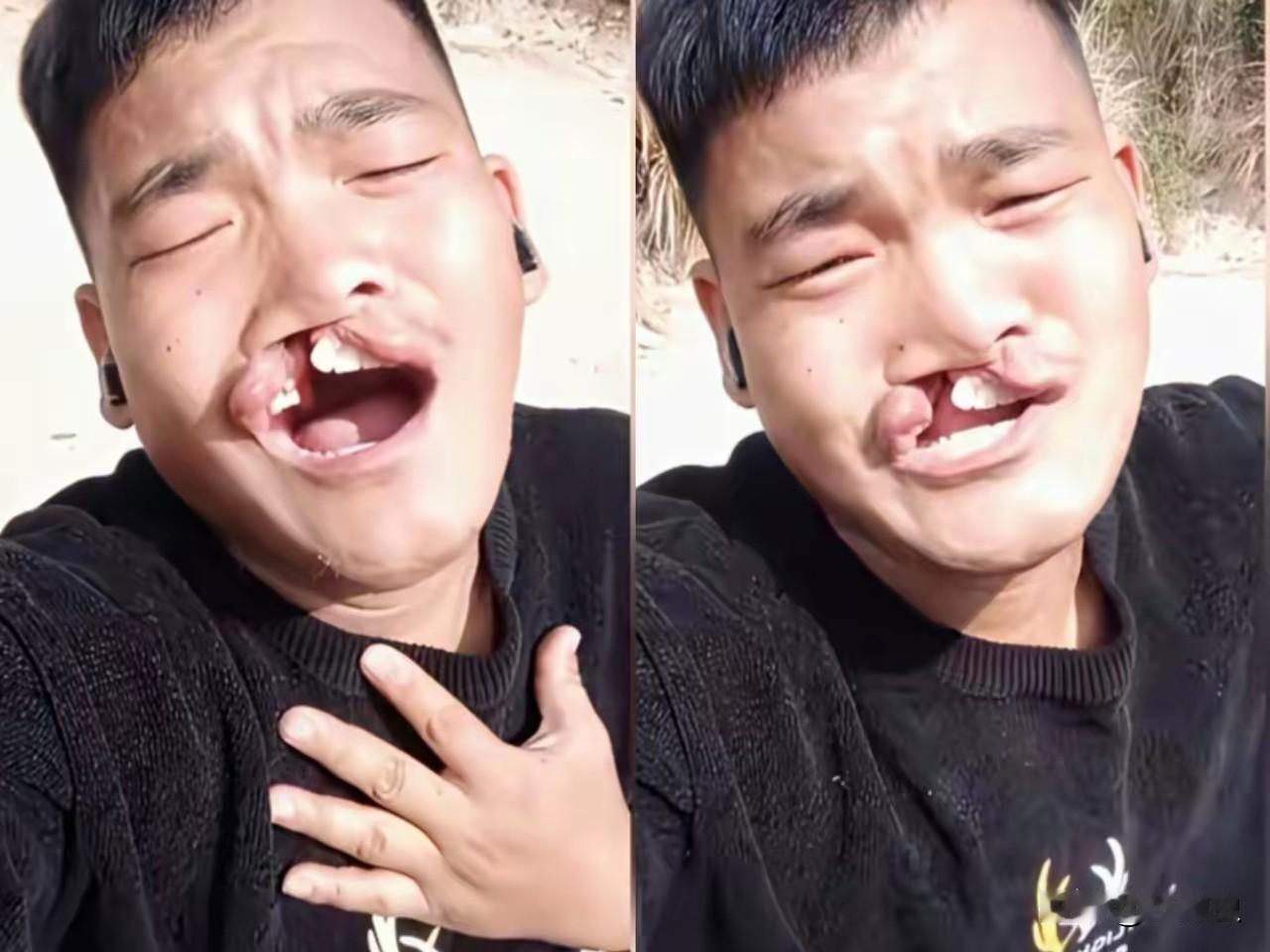 为什么兔唇患者，要早点治疗。治疗兔唇患者，必须从儿童抓起。一旦兔唇患者随着年