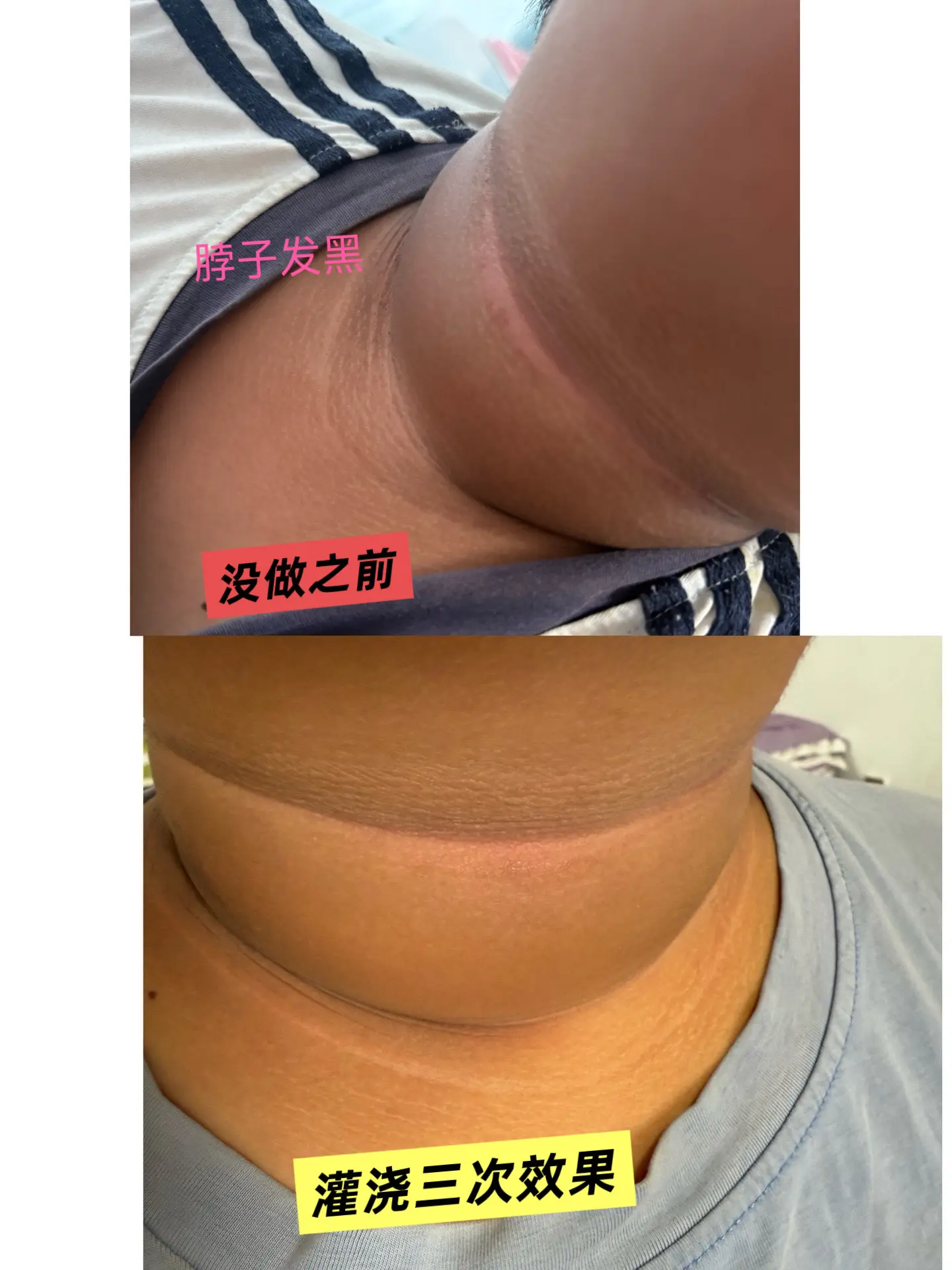 很多人以为脖子发黑，只是没洗干净🧐 使劲搓澡也完全没有变化 其实这是...