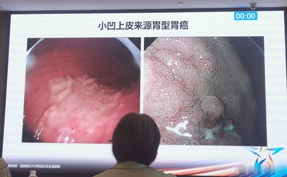 小凹上皮来源胃型胃癌：内镜下表现：部分小凹上皮来源胃型胃癌在白光内镜下表现为发红