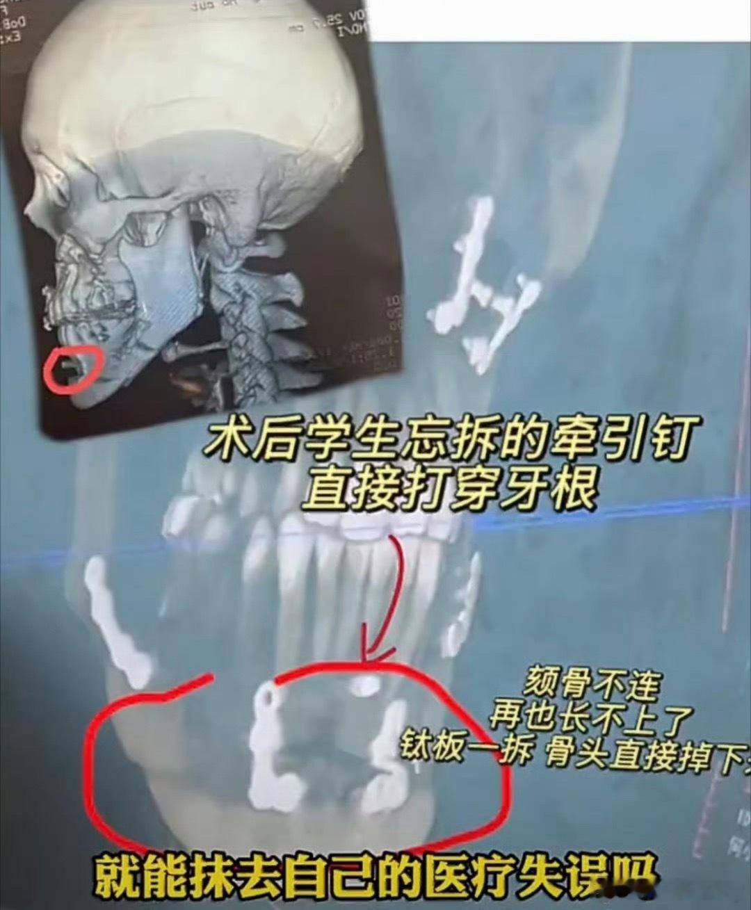 正颌手术做反了女孩说迎接她的是毁灭离谱到窒息的医疗事故！只需要微调2毫米的轻微地