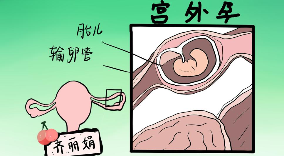 宫外孕到底有多危险，看完别再糊涂了很多女生对宫外孕，容易走两个极端：一种是