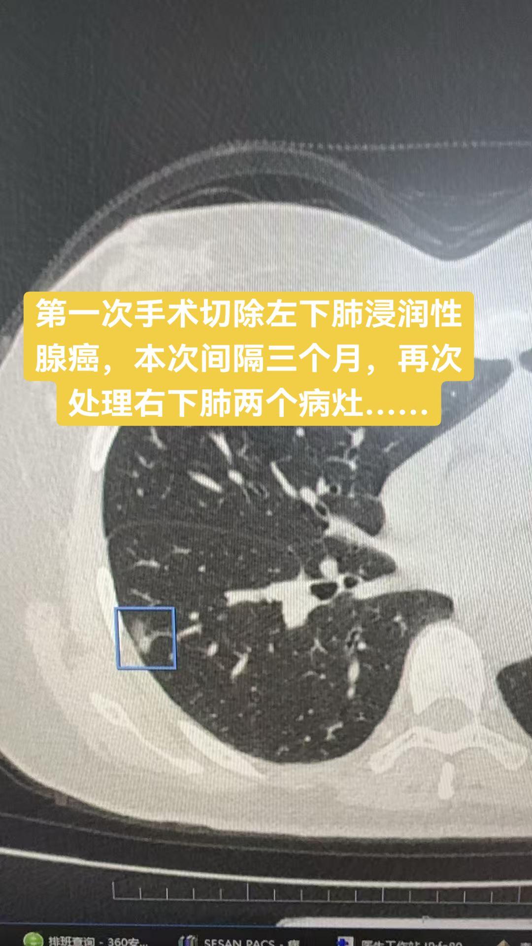 多源发肺癌……多源发肺癌很繁琐，需要分次手术，第一次手术切除左下肺浸润...