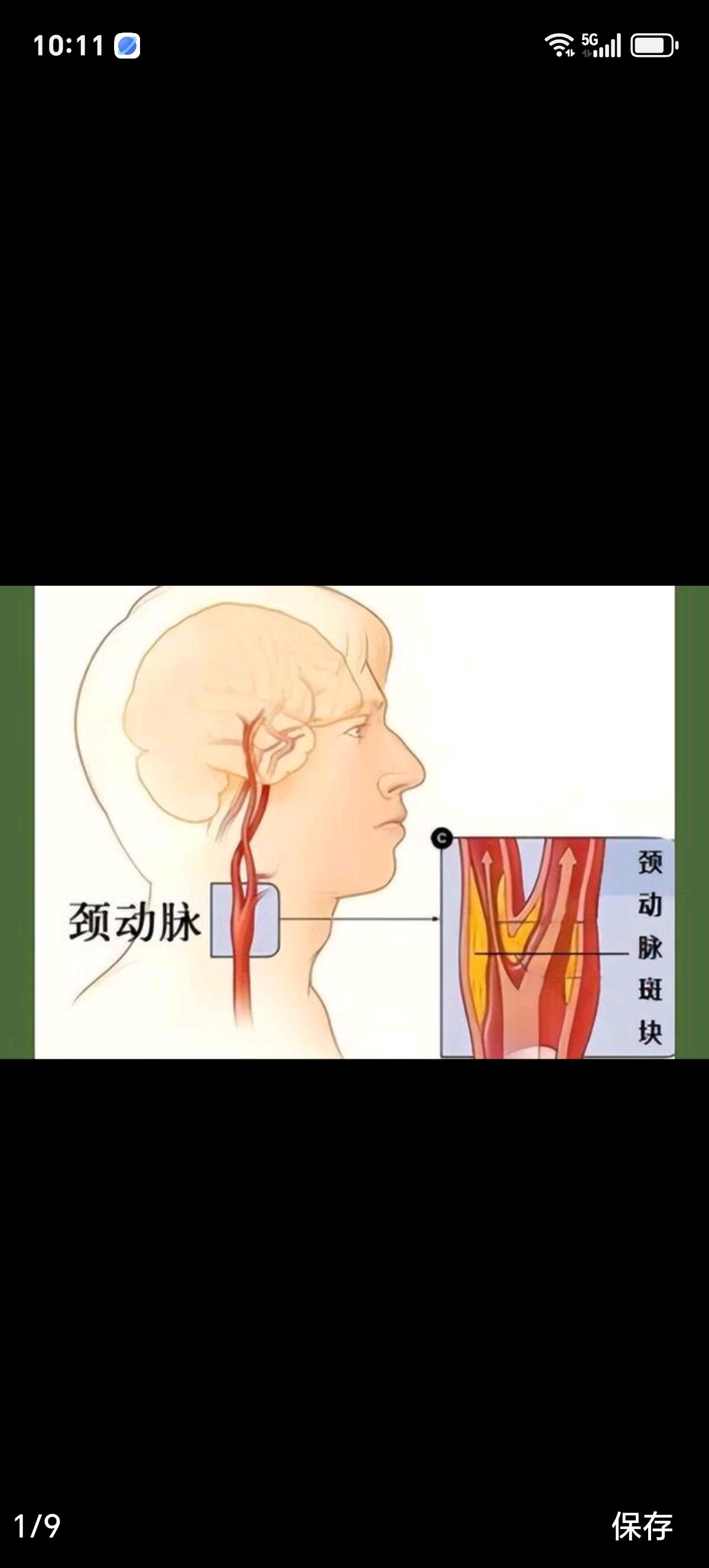 4种极易被忽视的日常习惯，悄悄加速血管老化很多人以为血管变硬是老年人专属问
