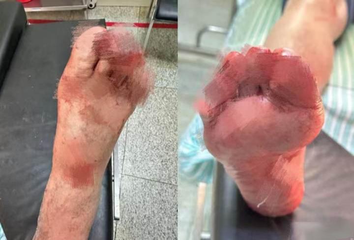 西湖大学医学院附属杭州市第一人民医院急诊科曾一晚上接连收到两起特殊的外伤病例，伤