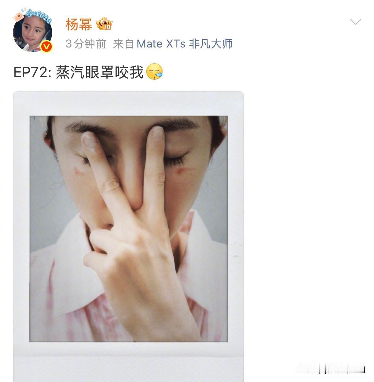 杨幂晒出眼周伤口，调侃，蒸汽眼罩咬我！让低温烫伤隐患冲上热搜。其实大家容易忽略这