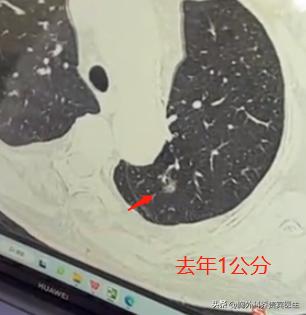 85岁老太太查出1cm肺结节没当回事，一年后确诊肺癌！这个病例给所有人敲响警钟！