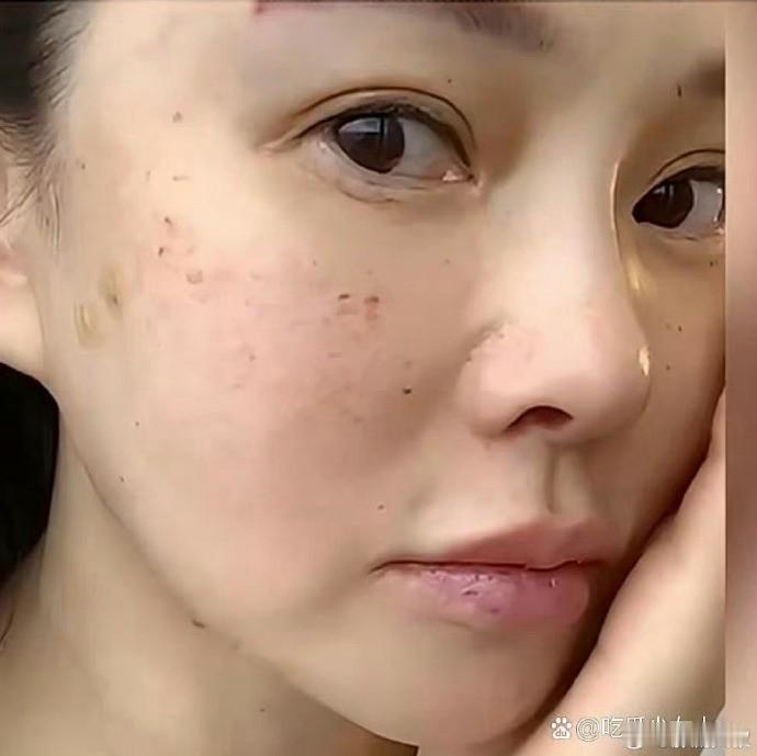 伊能静大方晒出自己的打针照片，果然，女明星为了容颜不老都很拼​​​