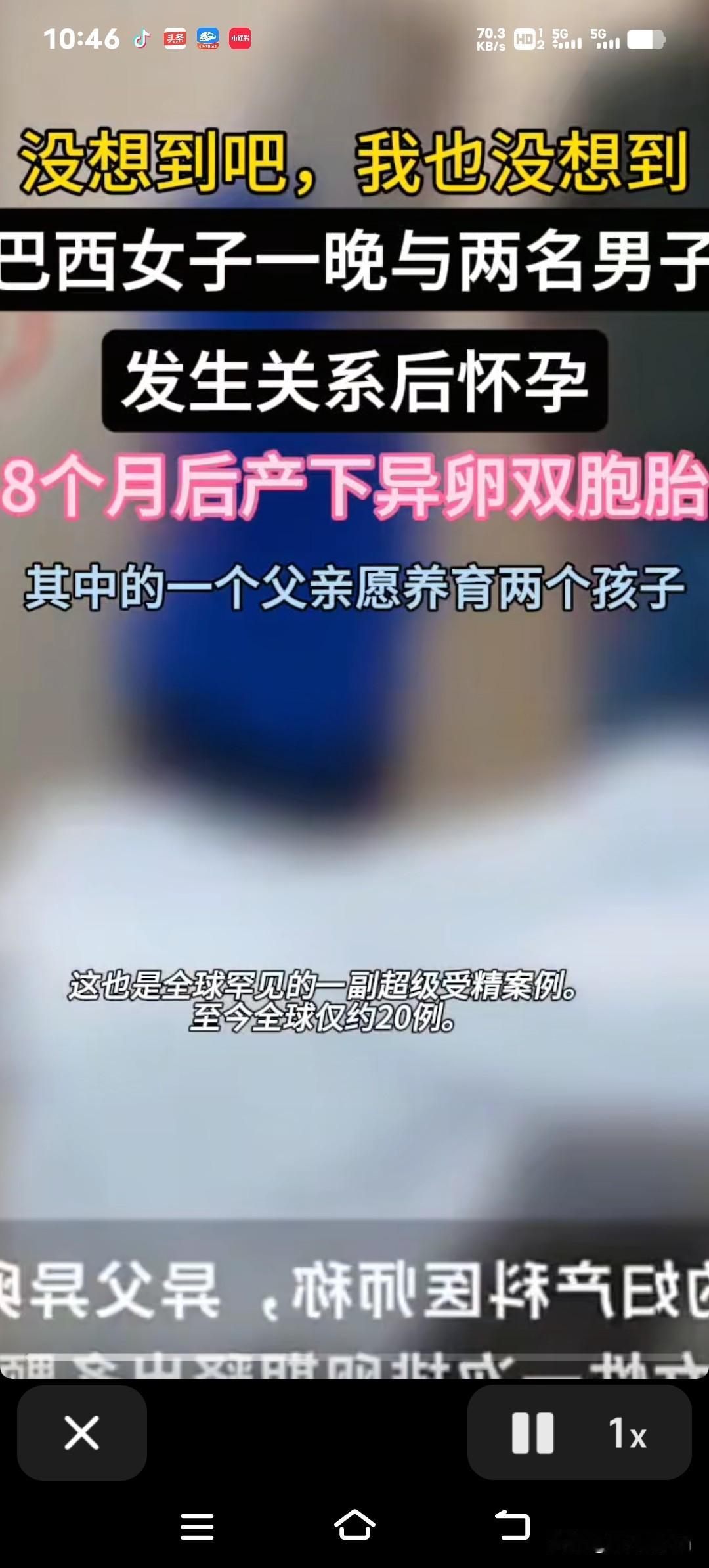 全球可能也就20来个这样的例子！巴西有位女士，某天晚上和两个不同的男生在一起，后