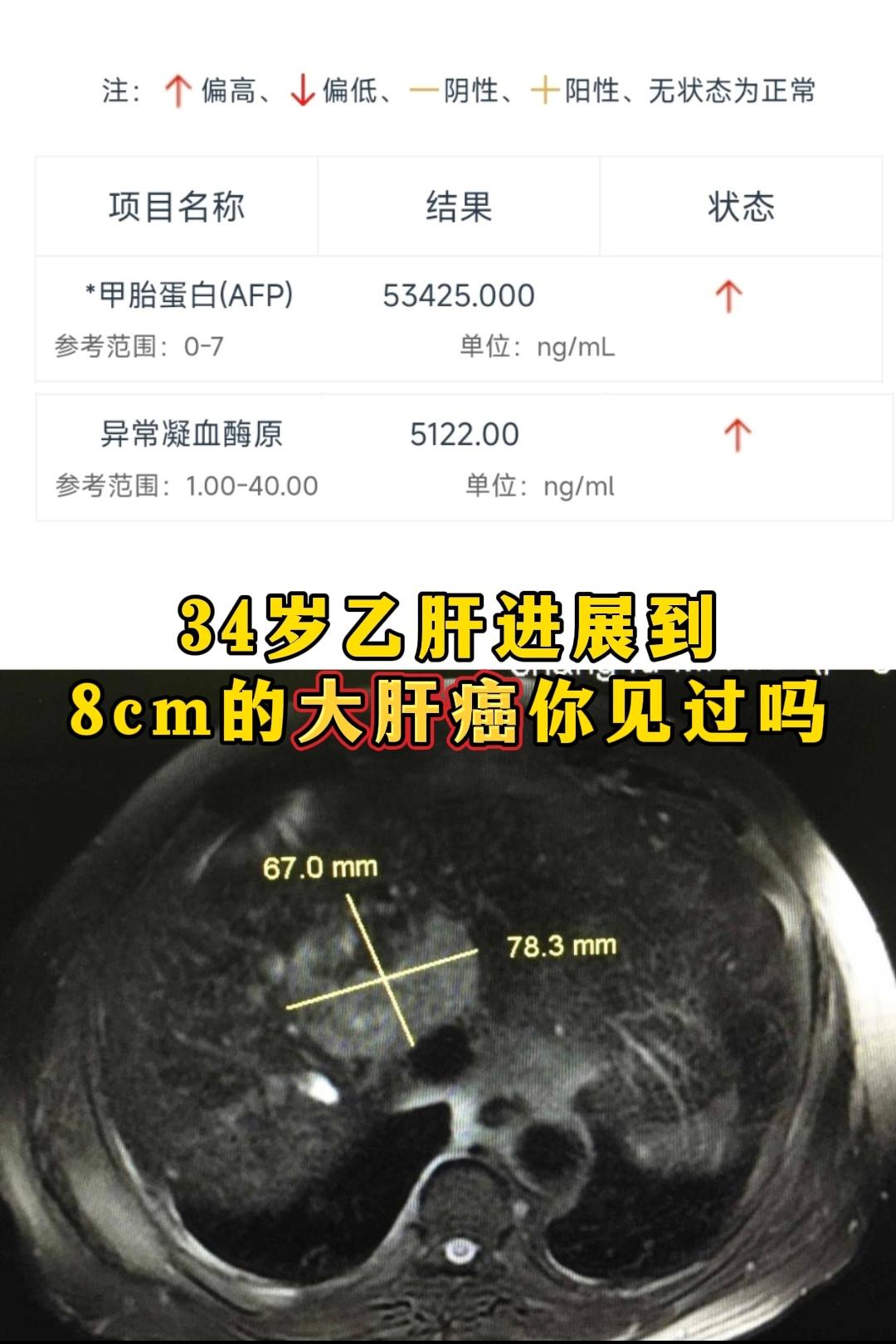 34岁就肝癌你见过吗？。这是今天刚入院的一位肝癌患者，年龄34岁，家是...