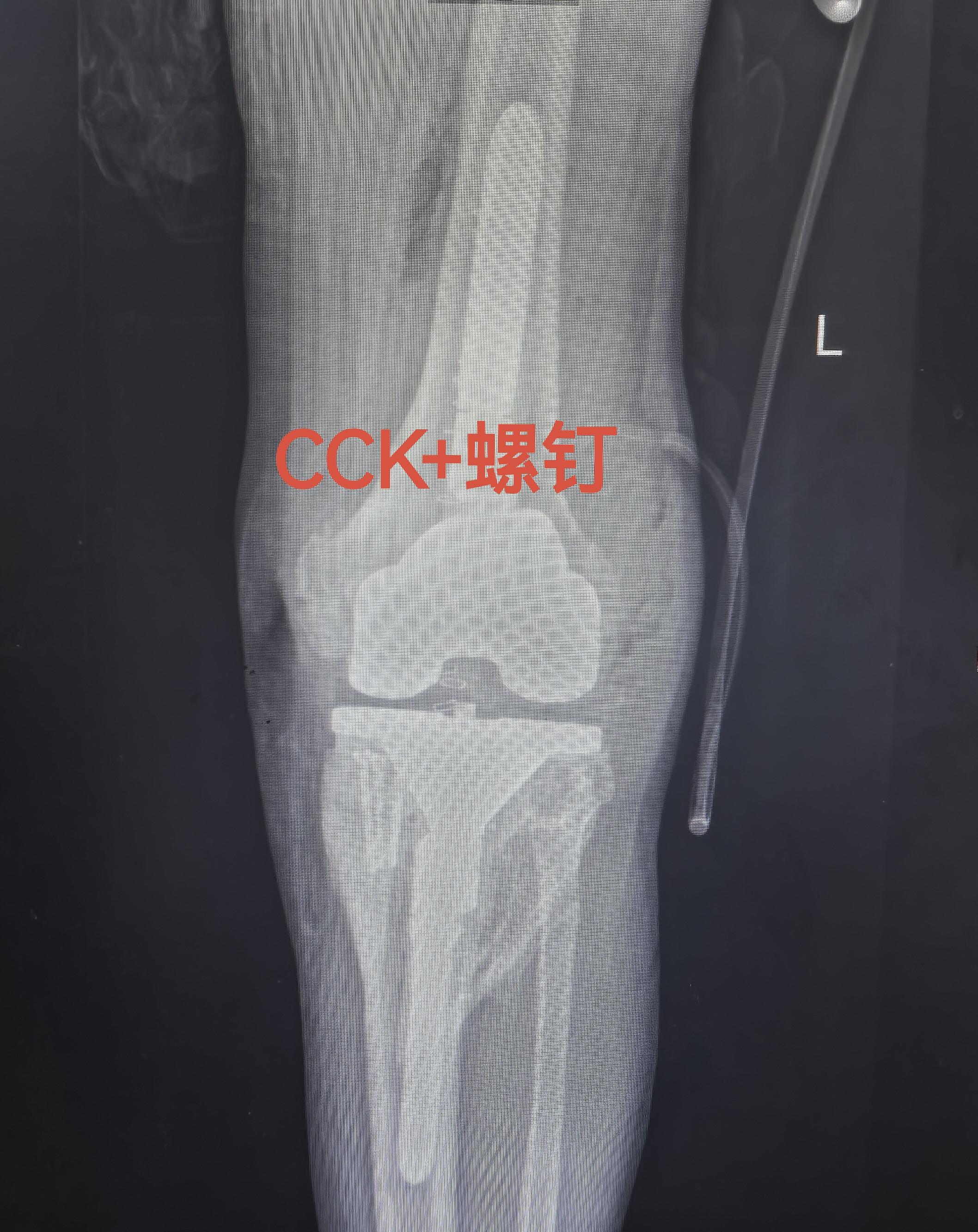 骨关节炎，膝关节置换。（这几天一忙忘了，接上一条）术后第二天晨查房，看...