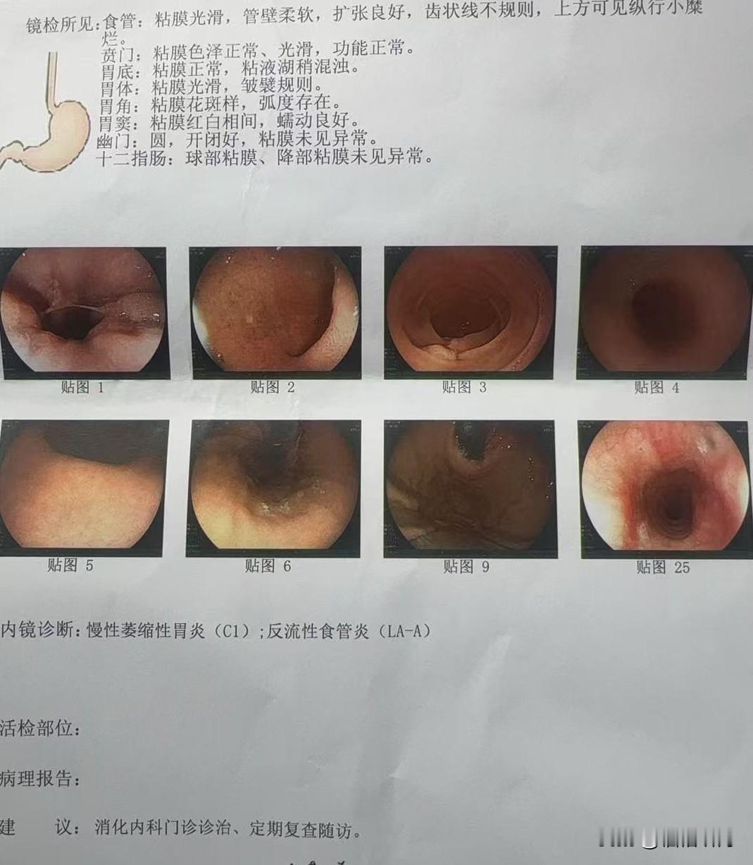 自从胃肠镜后，知道自己萎缩性胃炎C1，反流性食管炎LA-A，查看了很多相关信息，