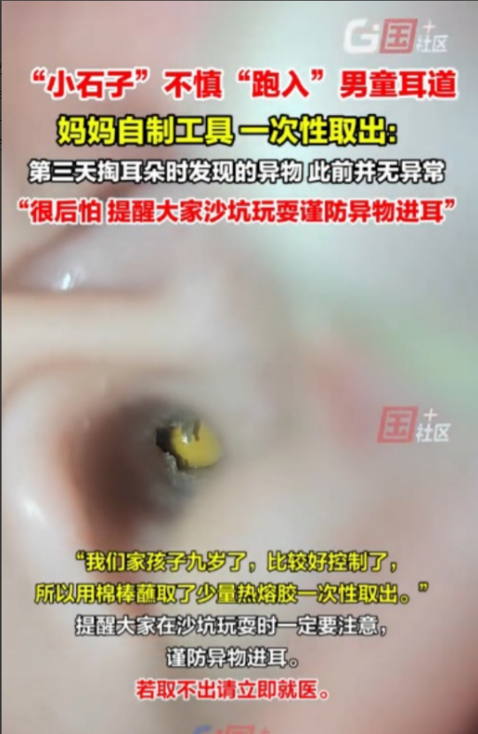 “人怎么能这么聪明！”5月8日，山东东营，一母亲给孩子掏耳朵时，竟发现孩子耳道深