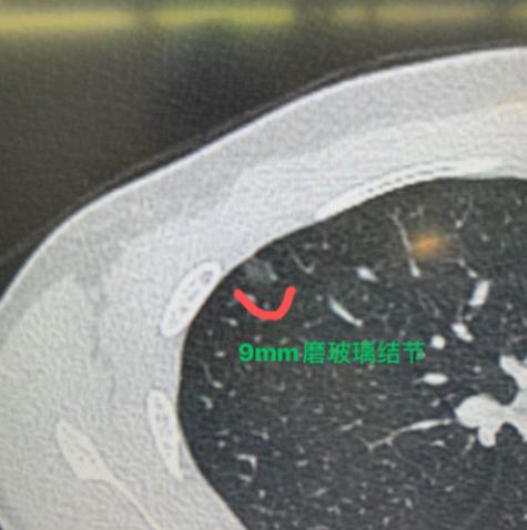 这个小伙子25岁，为了肺上一个9mm的磨玻璃结节，前前后后跑来找了我三次，每次都