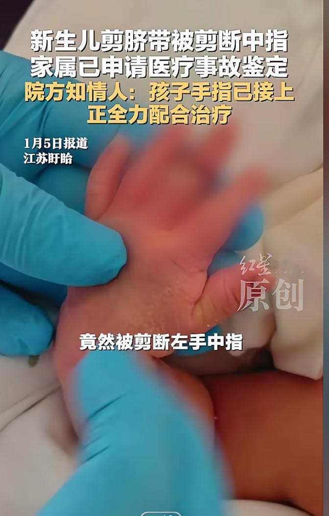 太离谱了，新生儿剪脐带竟然被剪断中指，这错误也太离谱了。2025年12月25