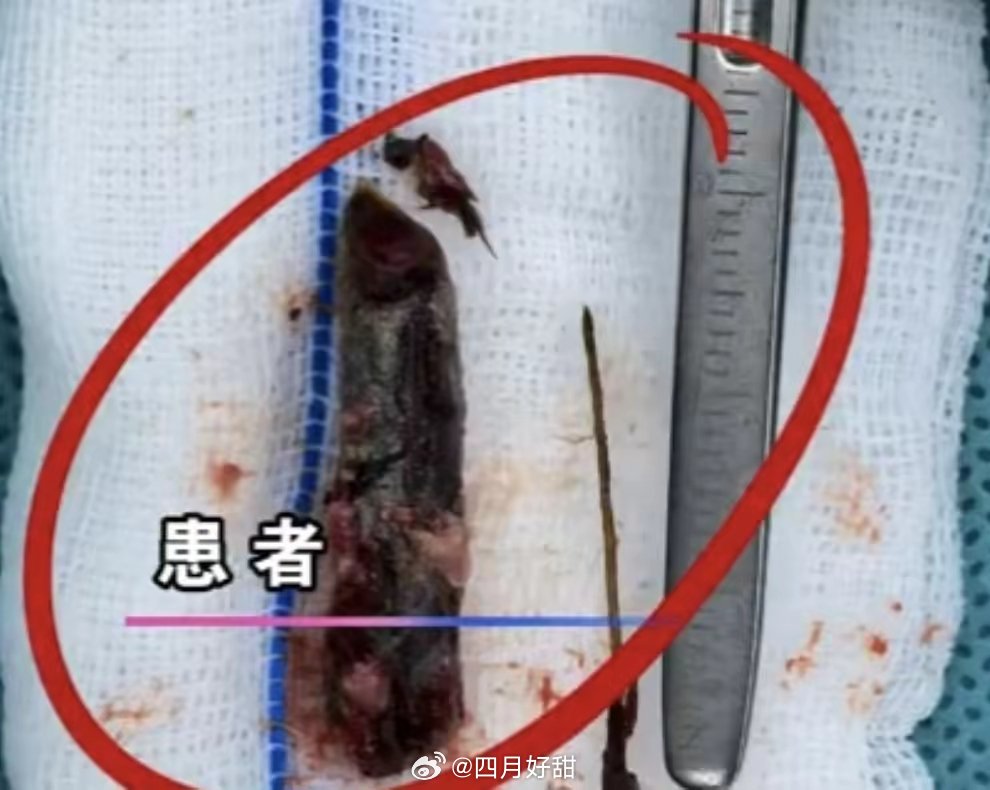 一直各种鼻子不舒服去医院也检查多次，一直被当鼻炎治疗，持续了18年。原来18年前