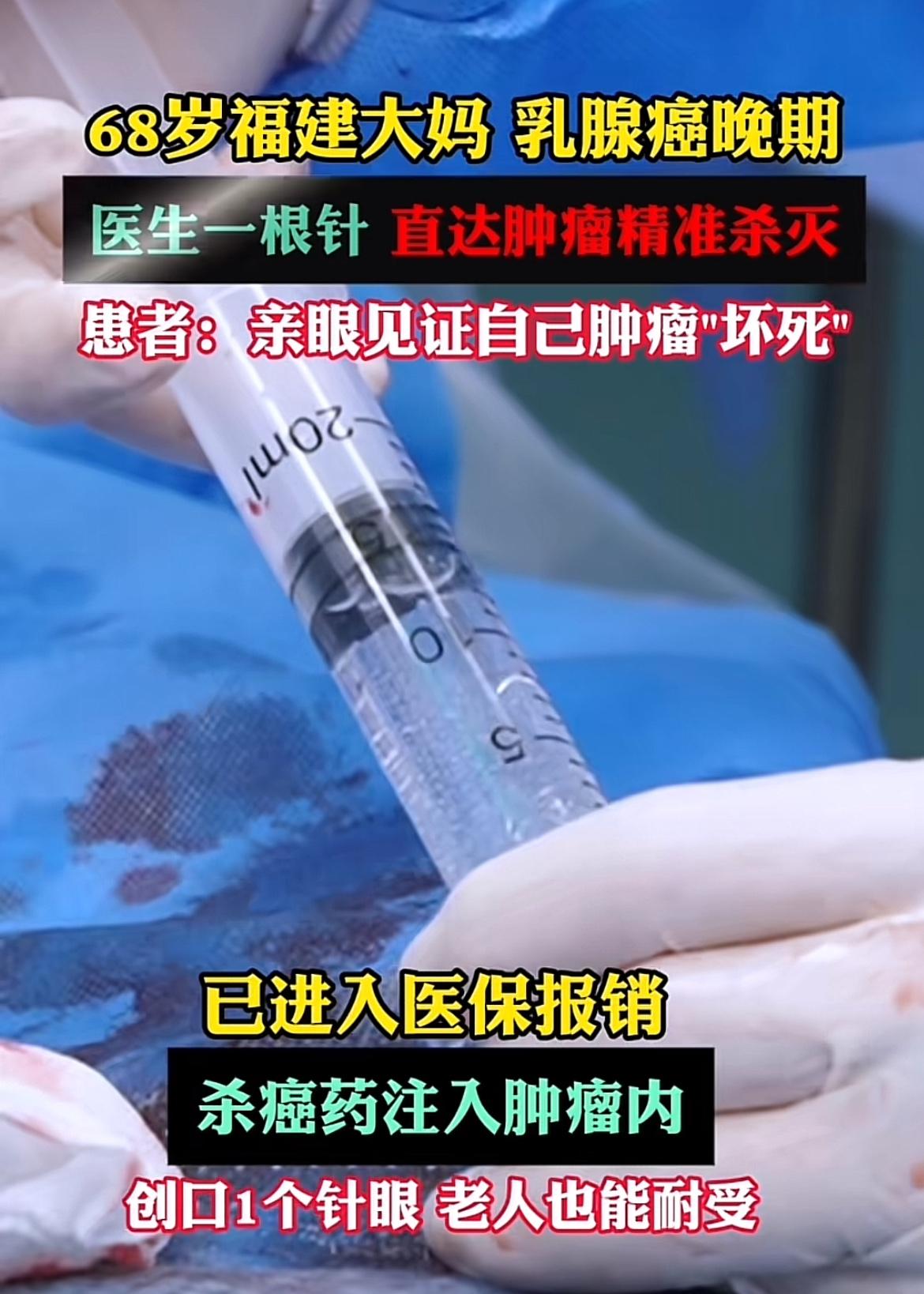 68岁福建大妈患乳腺癌晚期，医生一针精准杀灭肿瘤，这简直是医学奇迹！就像有位68