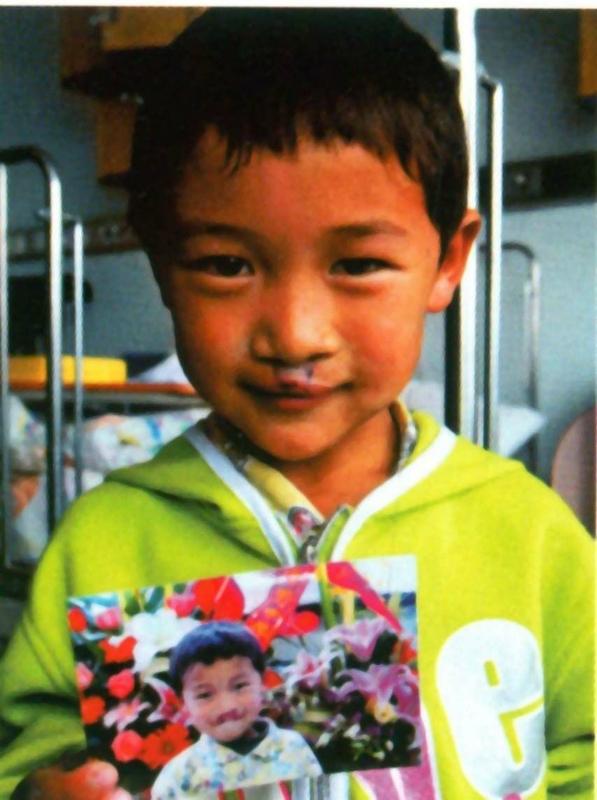 嫣然天使基金在救助兔唇患者方面成果显著。据公开信息，嫣然天使儿童医院十年间完成1