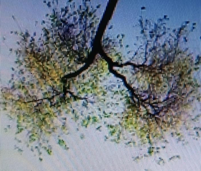 双肺纹理增多，就是胸部X线或CT影像里，肺部纹理线条比正常更密集明显。这可能是多