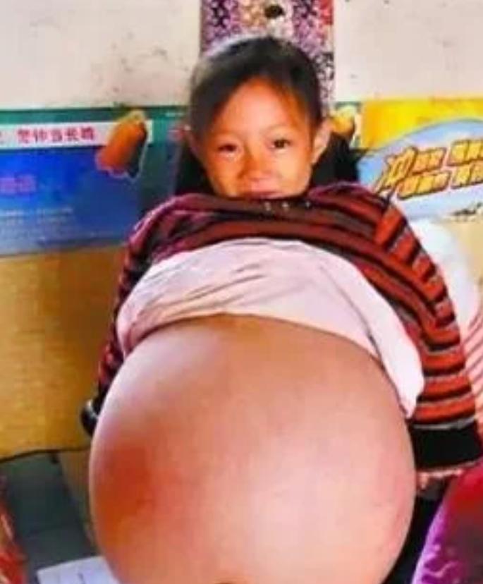 2010年山西一个4岁小女孩，肚子一天天鼓起来，最后胀得像揣了个足月胎儿。医院跑