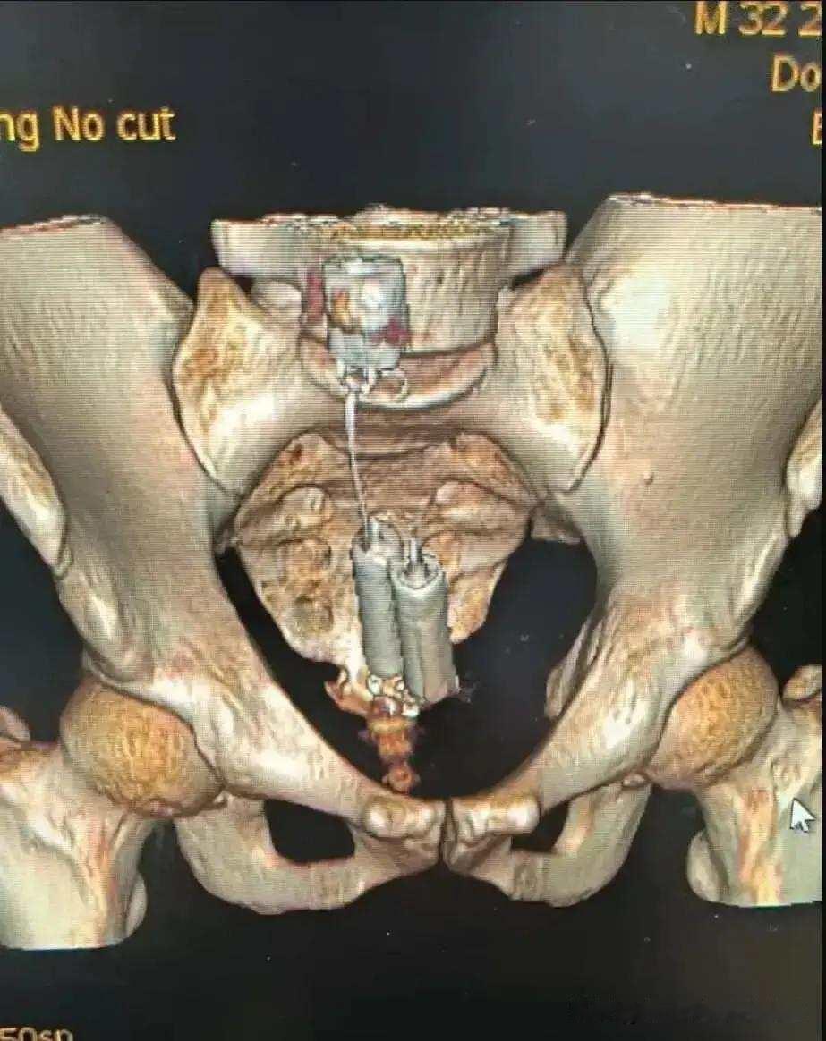 “洗澡滑倒，一屁股坐进去了”。这大概是放射科医生听过最统一的借口，可真有人信