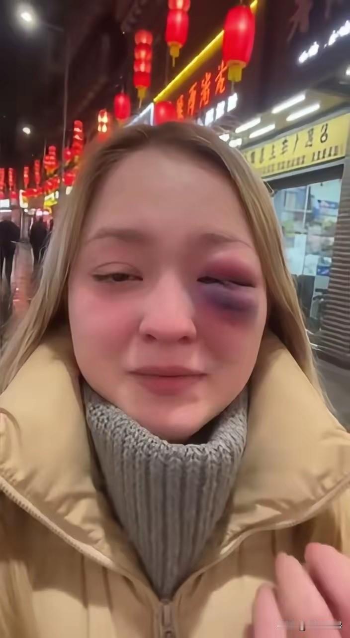 女子的眼睛据说是被她丈夫给打的，经常挨打，没有办法，于是拿着护照从俄罗斯来到了我