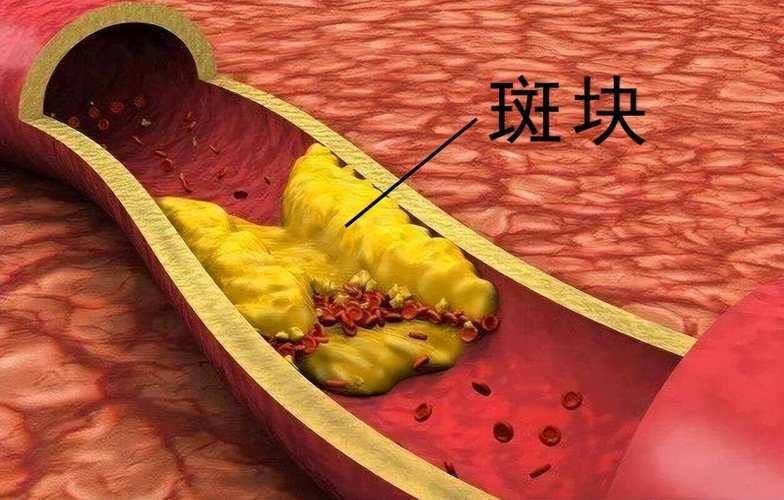 吃他汀后，如何判断动脉斑块有没有好转？4个变化告诉你效果有些人吃上他汀后，总