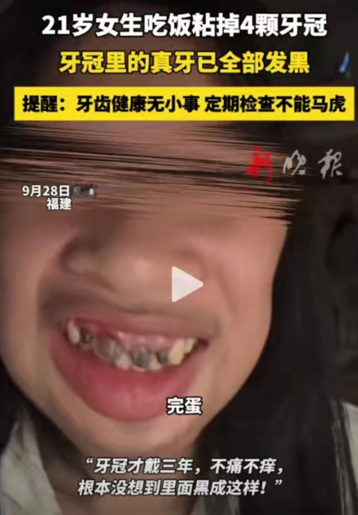 21岁女生吃饭竟掉4个牙冠真牙全黑！网友我的牙也不行了21岁女生在用餐时
