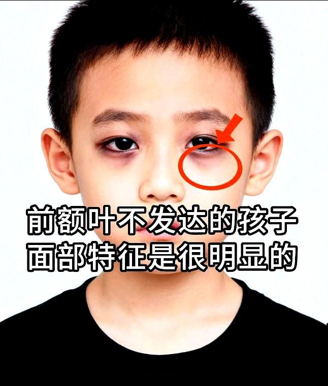 前额叶不发达的孩子面部特征其实很明显！天哪，每次看到那些前额扁平、眼神涣散的小