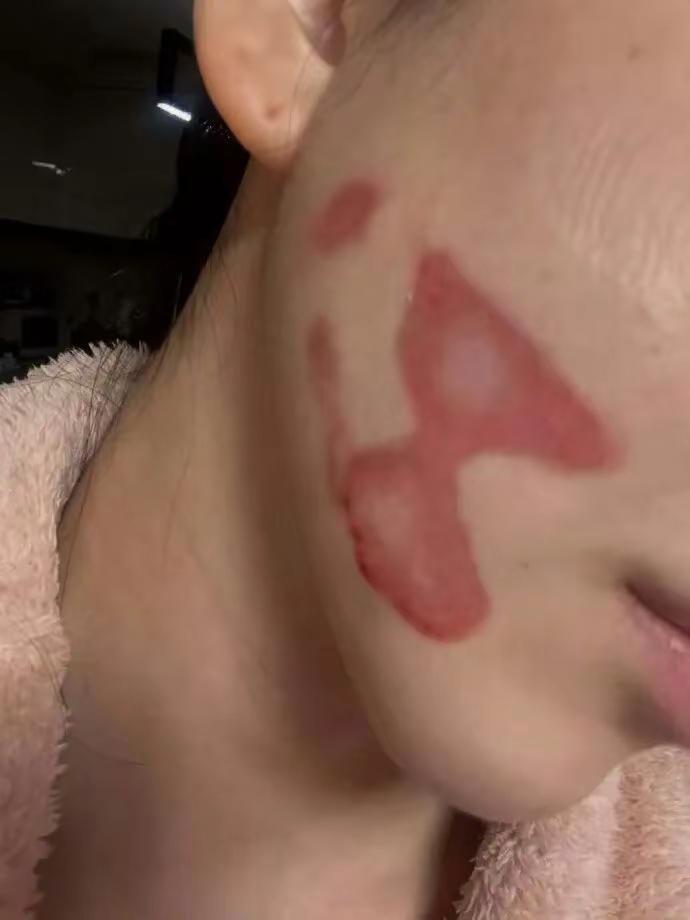 女偶像医美后毁容？！。自曝脸部二度烧伤照！痛哭喊：皮肤像被撕开...工作全完了.