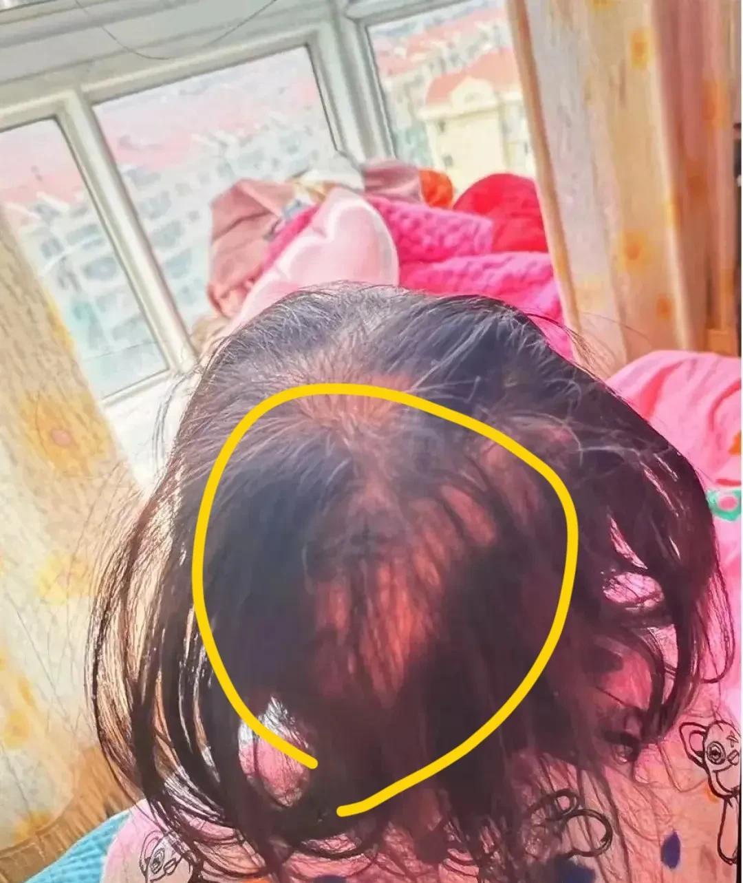 山东三岁女孩命悬一线，投毒者罪大恶极近期，一则关于“3岁女童突现脱发与呆滞眼神