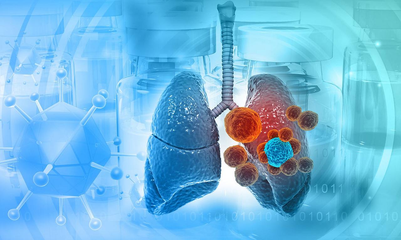 复旦解剖326名肺癌逝者，意外发现：得肺癌的人，大多有这5共性研究团队通过系