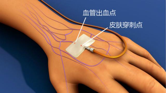 输液后手背淤青肿胀, 也许是因为你不会按压