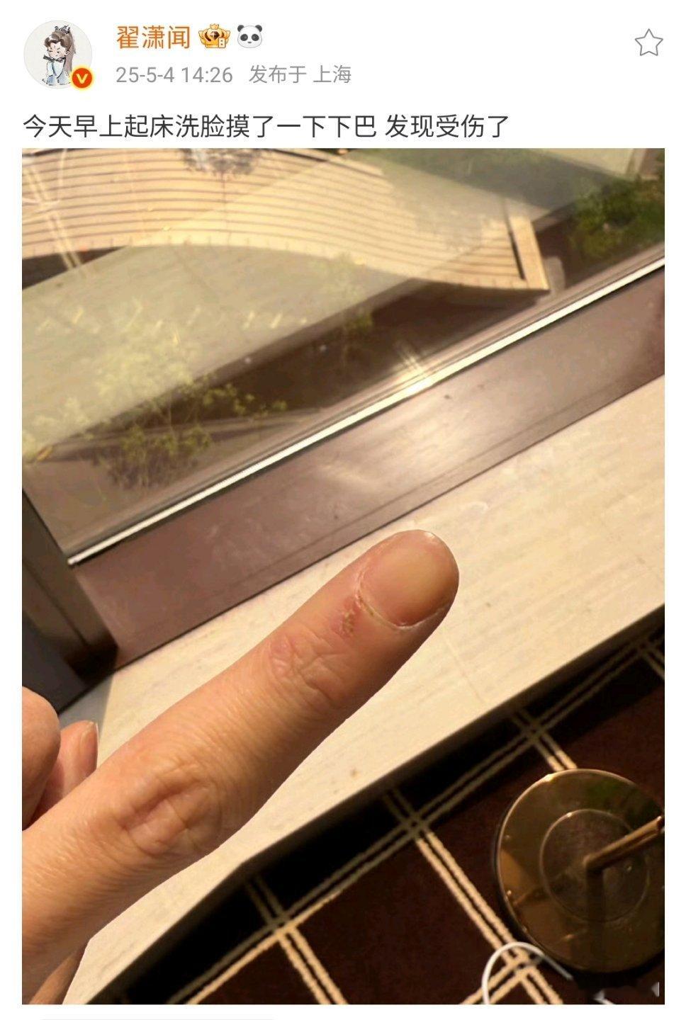 翟潇闻摸了一下下巴受伤了翟潇闻被下颌线划伤了翟潇闻的抽象真的来的措手不及[捂脸哭]
