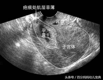 27岁孕妈怀孕7月被迫引产, 检查后医生告知原因, 产妇如晴天霹雳