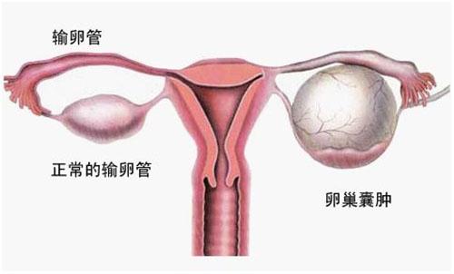卵巢囊肿严重吗 卵巢囊肿五大危害不容忽视