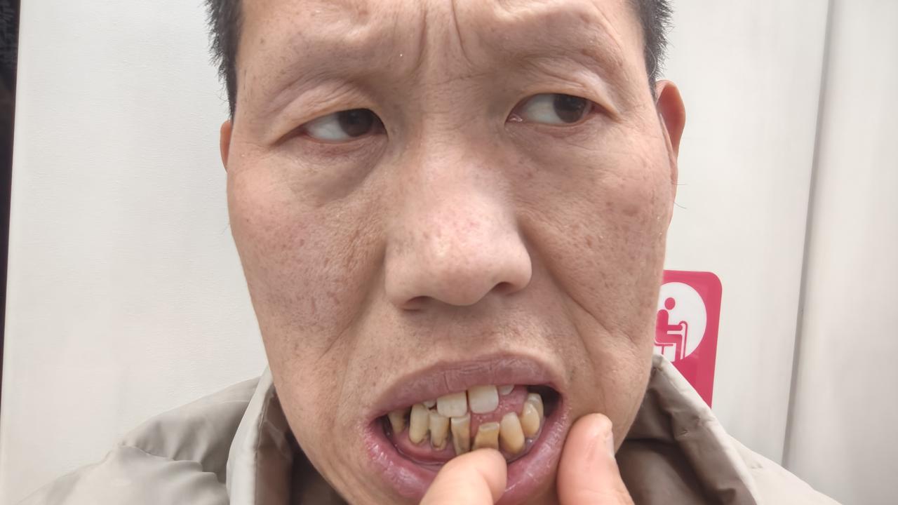 人到40，牙齿也跟着闹起了“革命”。就像我，门牙松动得厉害，吃东西疼得要命，却又